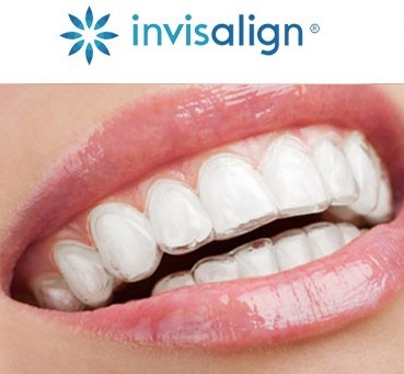 Photo of invisalign braces