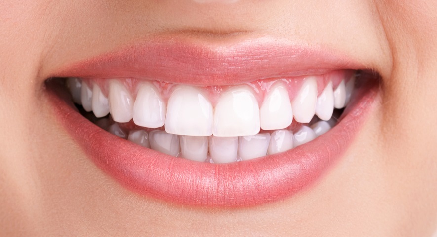 1689014640_veneers san diego