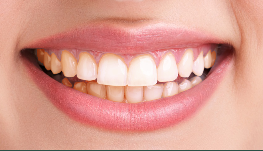 Gum_disease prevention