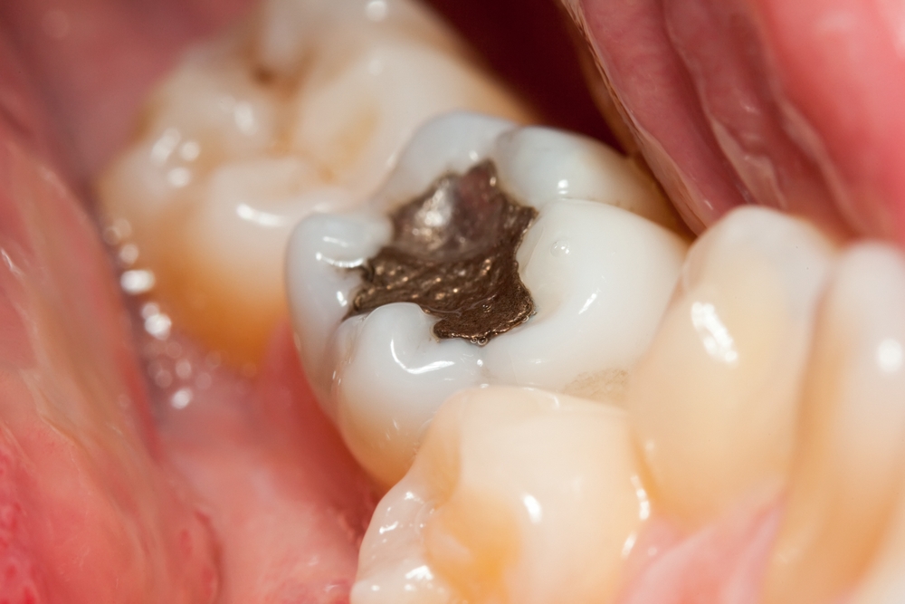 fillings